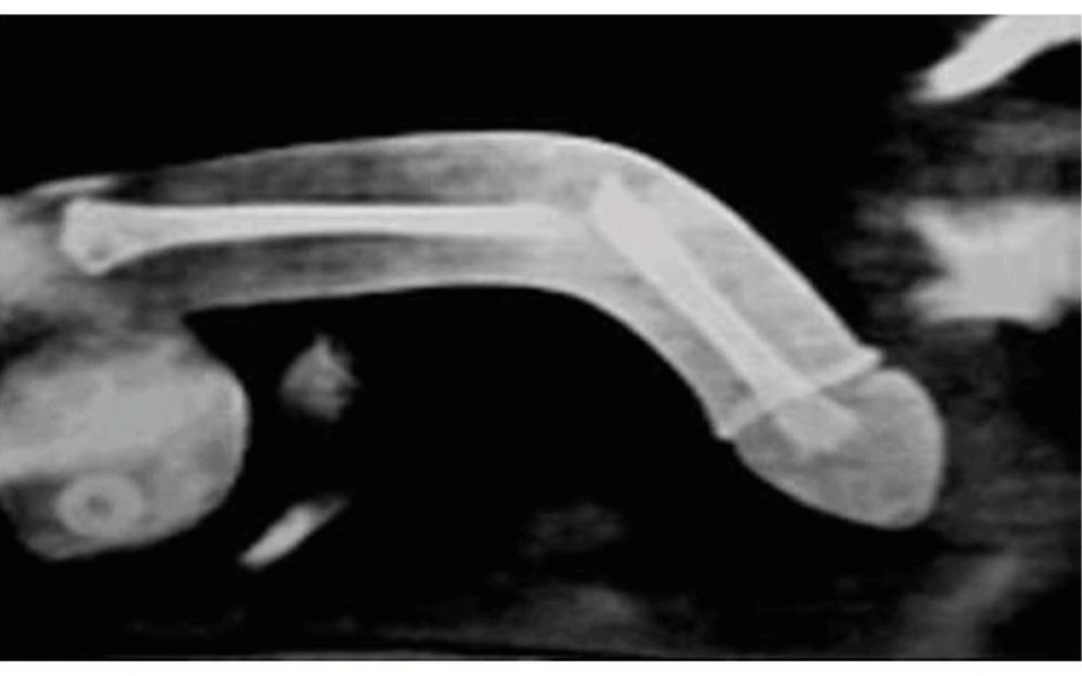 Penisbruch / penis fracture