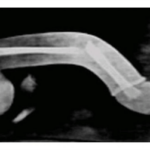 Penisbruch / penis fracture