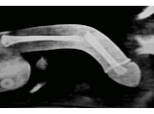 Penisbruch / penis fracture