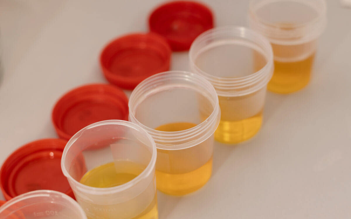 Blut im Urin Symbolbild: Urinproben in Bechern. Englisch: blood in urine symbolic image: Urine samples in cups