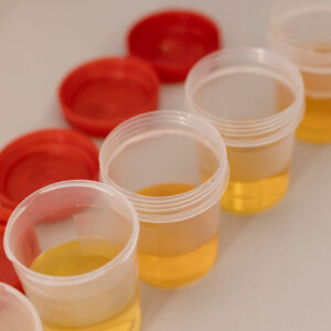 Blut im Urin Symbolbild: Urinproben in Bechern. Englisch: blood in urine symbolic image: Urine samples in cups